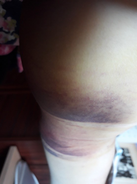 Bruised and bandaged arm