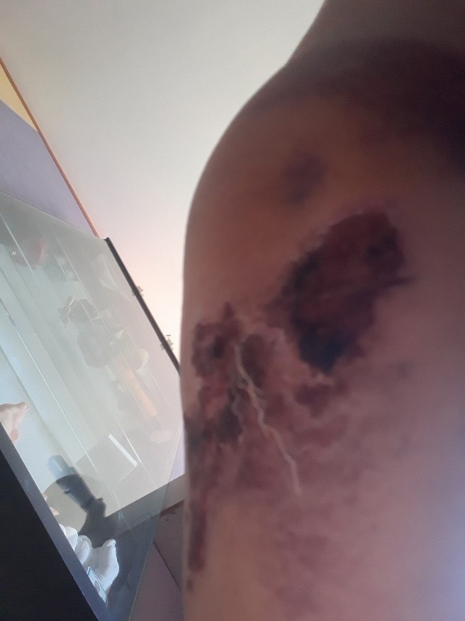 Scabby elbow