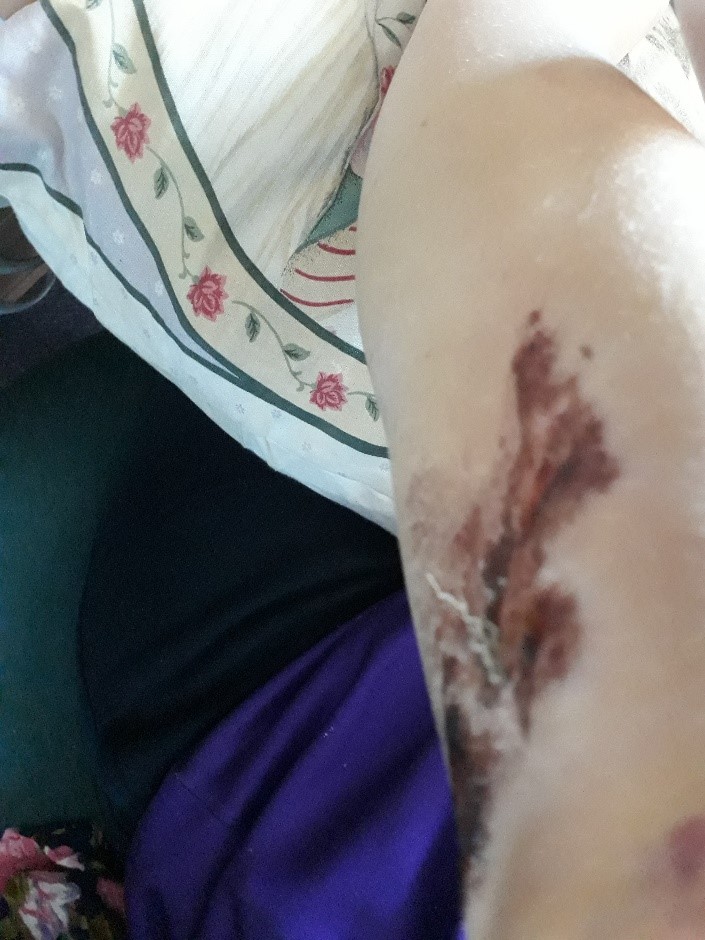 Scabby arm