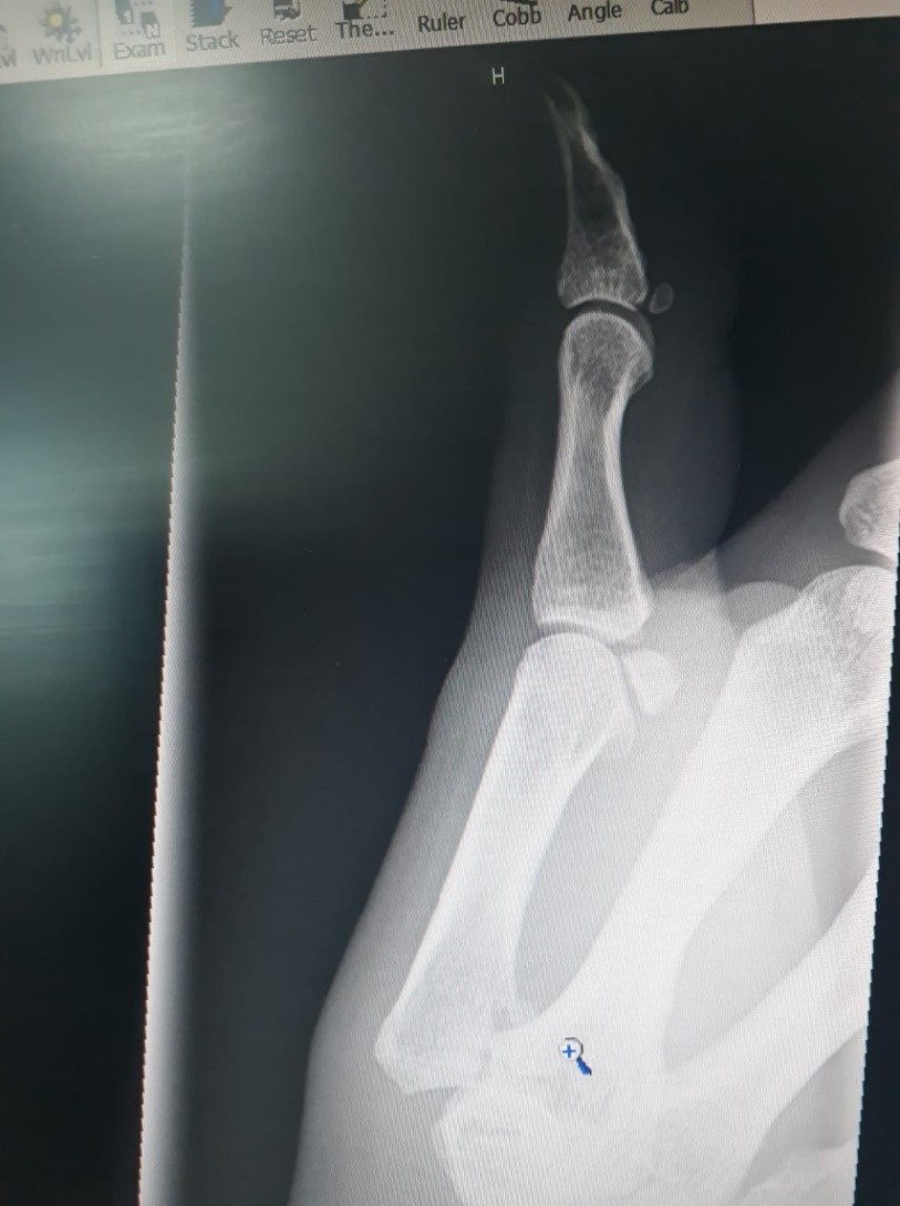 Thumb x-ray