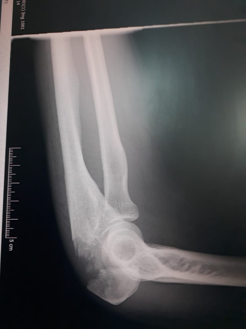 Elbow x-ray