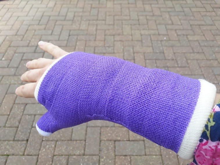 Purple plastercast