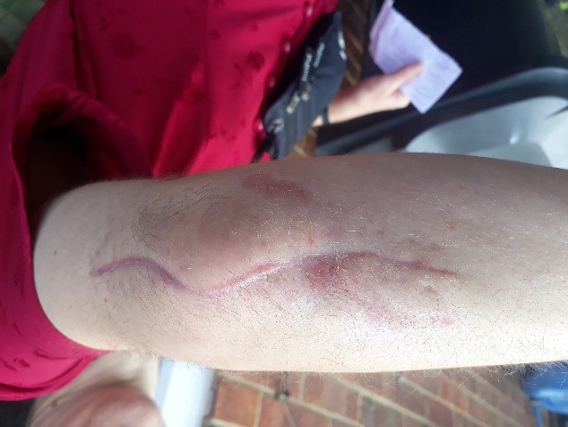 The scar