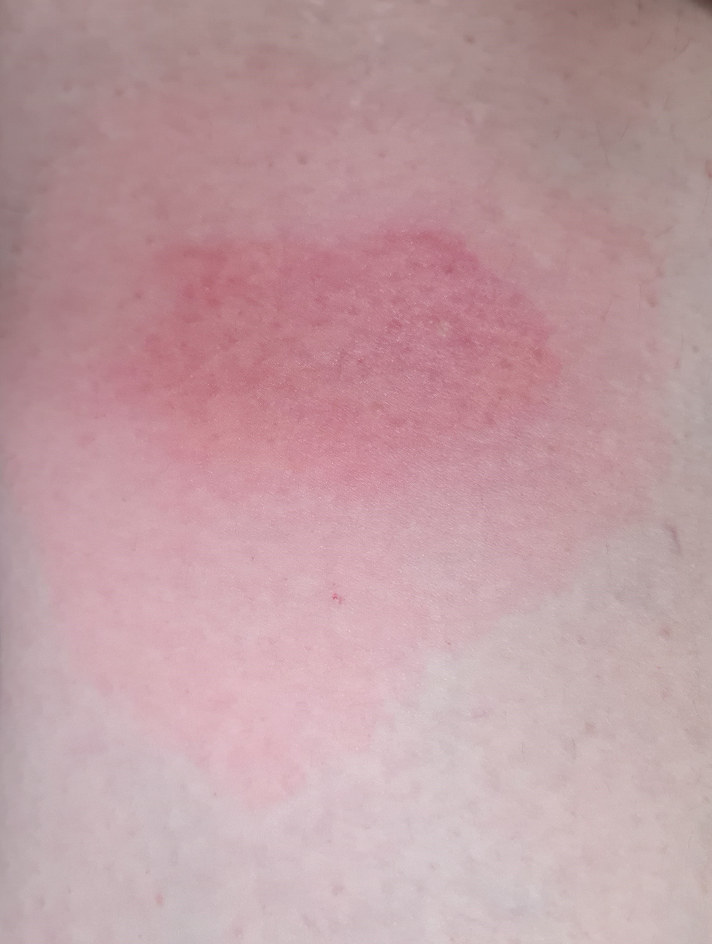Photo of stung leg